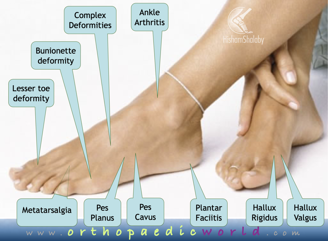 Minimally Invasive Foot Ankle Surgery Orthopaedic Foot Ankle