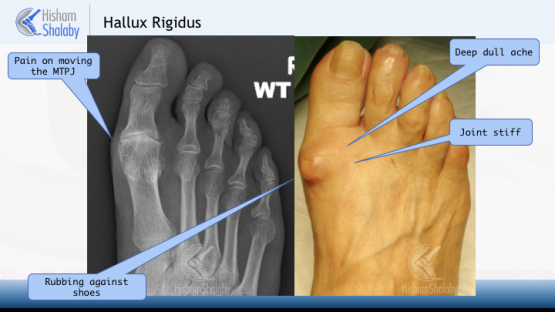 Hallux Rigidus Big Toe Arthritis - Consultant Orthopaedic Surgeon ...