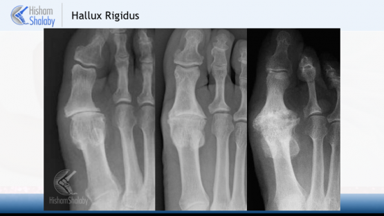 Hallux Rigidus Big Toe Arthritis Consultant Orthopaedics Edinburgh Mr